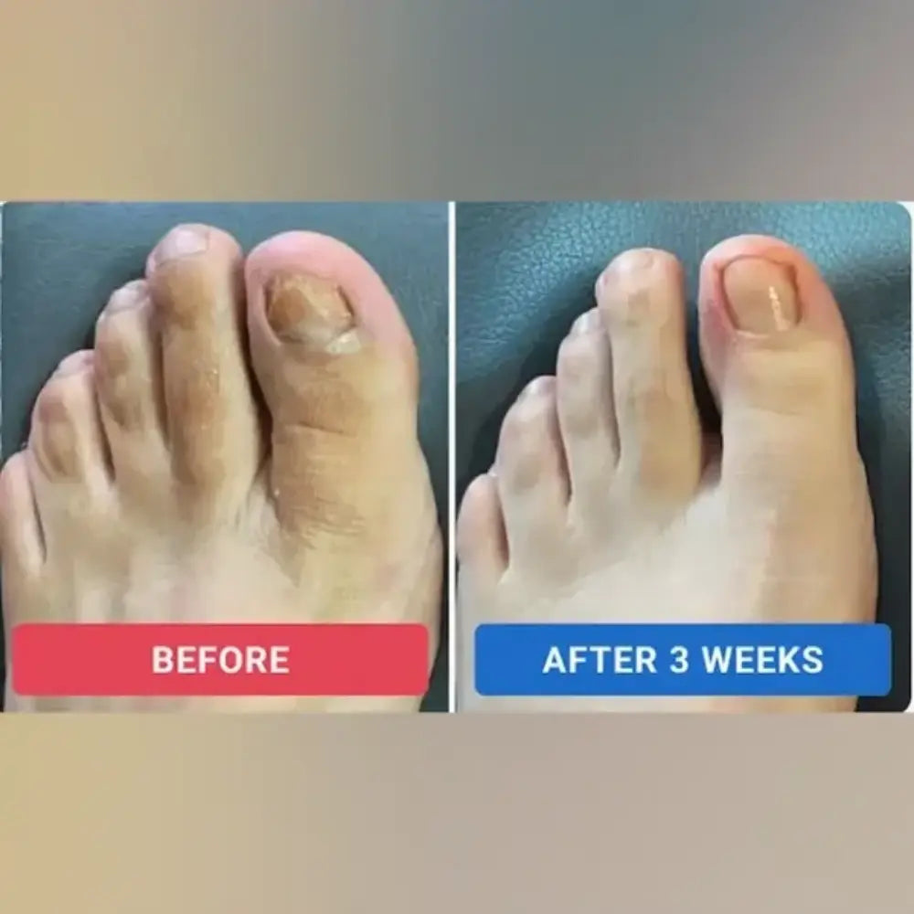 FungFree – Nail Repair Patches